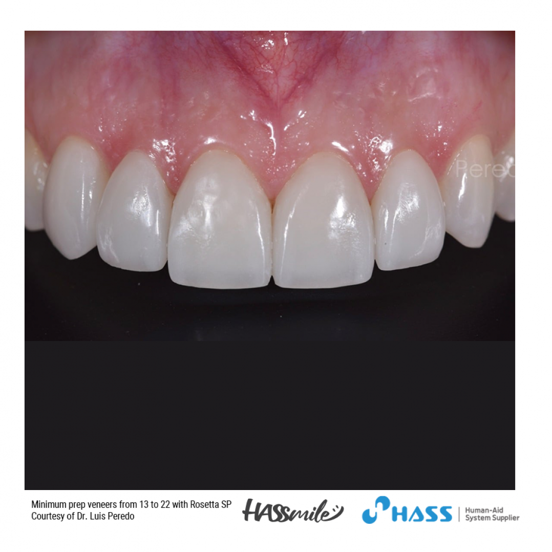 Minimum prep veneers from 13 to 22 with Rosetta SP HT W2